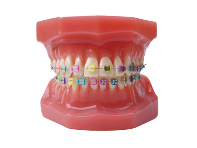 HST-B6-02 Ortho Metal & Ceramic Bracket Model