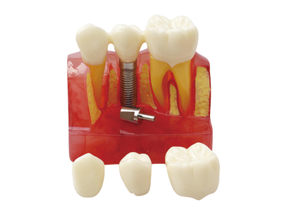 HST-M3-01 4 Times Implant Model