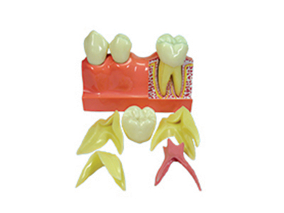 HST-M4-01 4Times Sized Tooth Disassembling Model